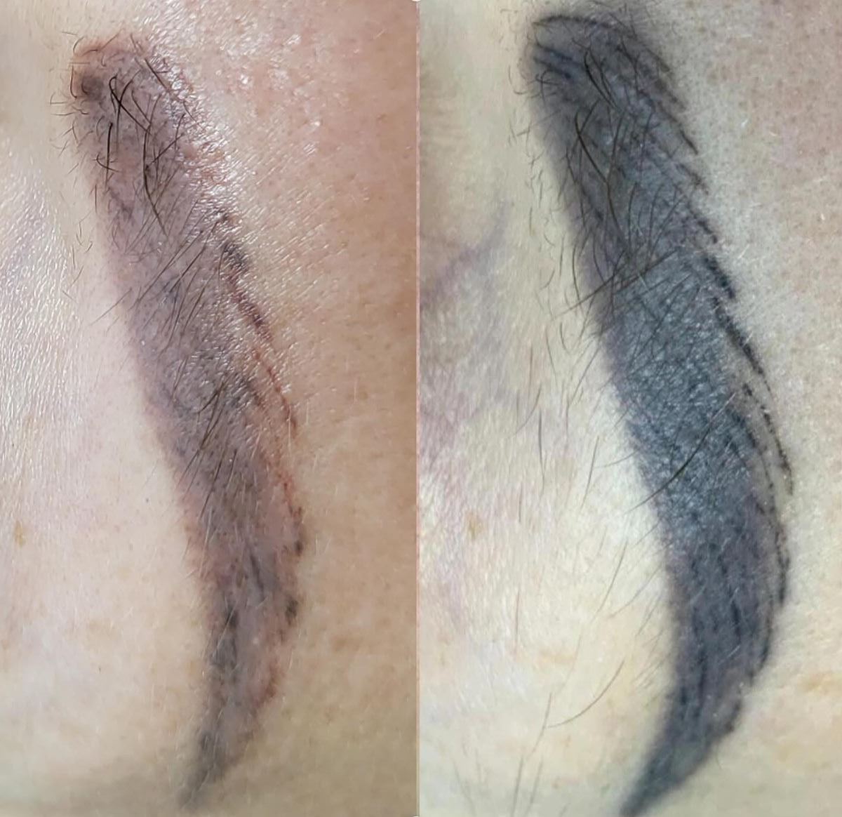 Saline tattoo removal