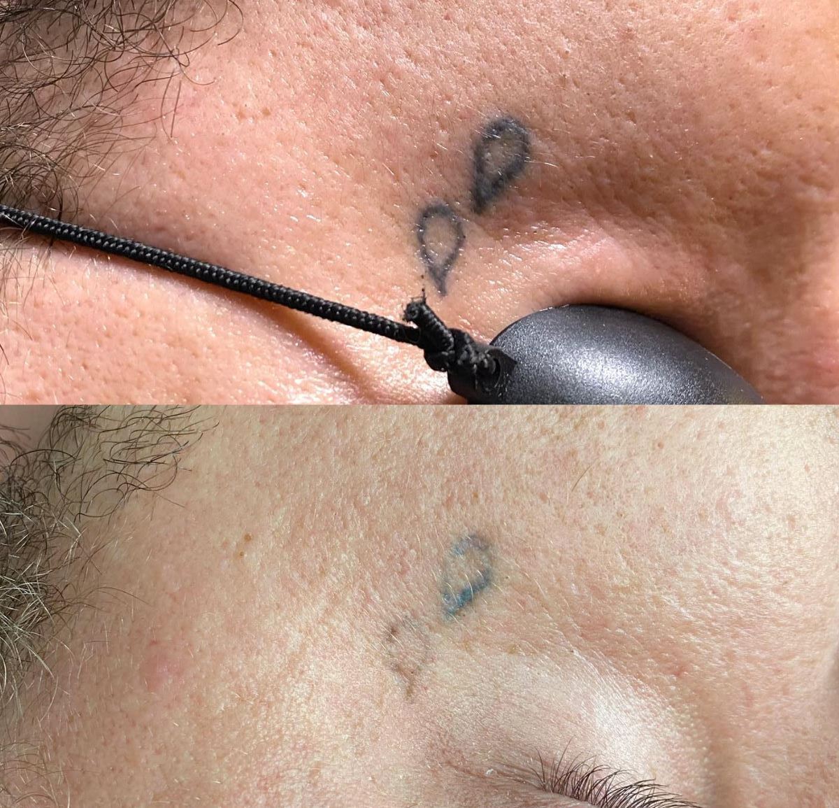 tattoo removal course