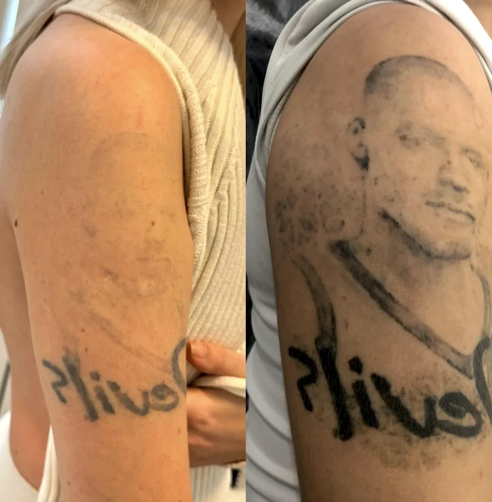 affordable tattoo removal melbourne