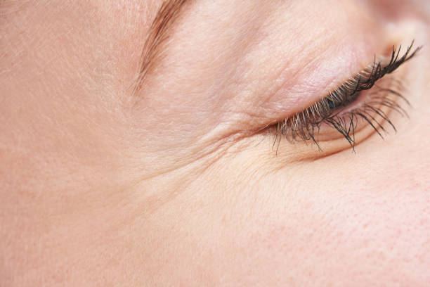 what is crow's feet around the eyes