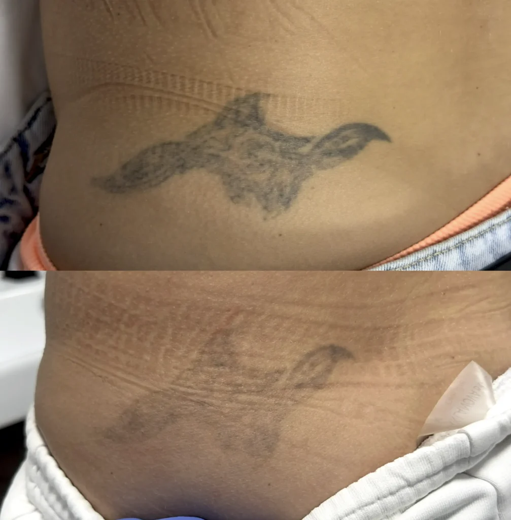 laser tattoo removal deals