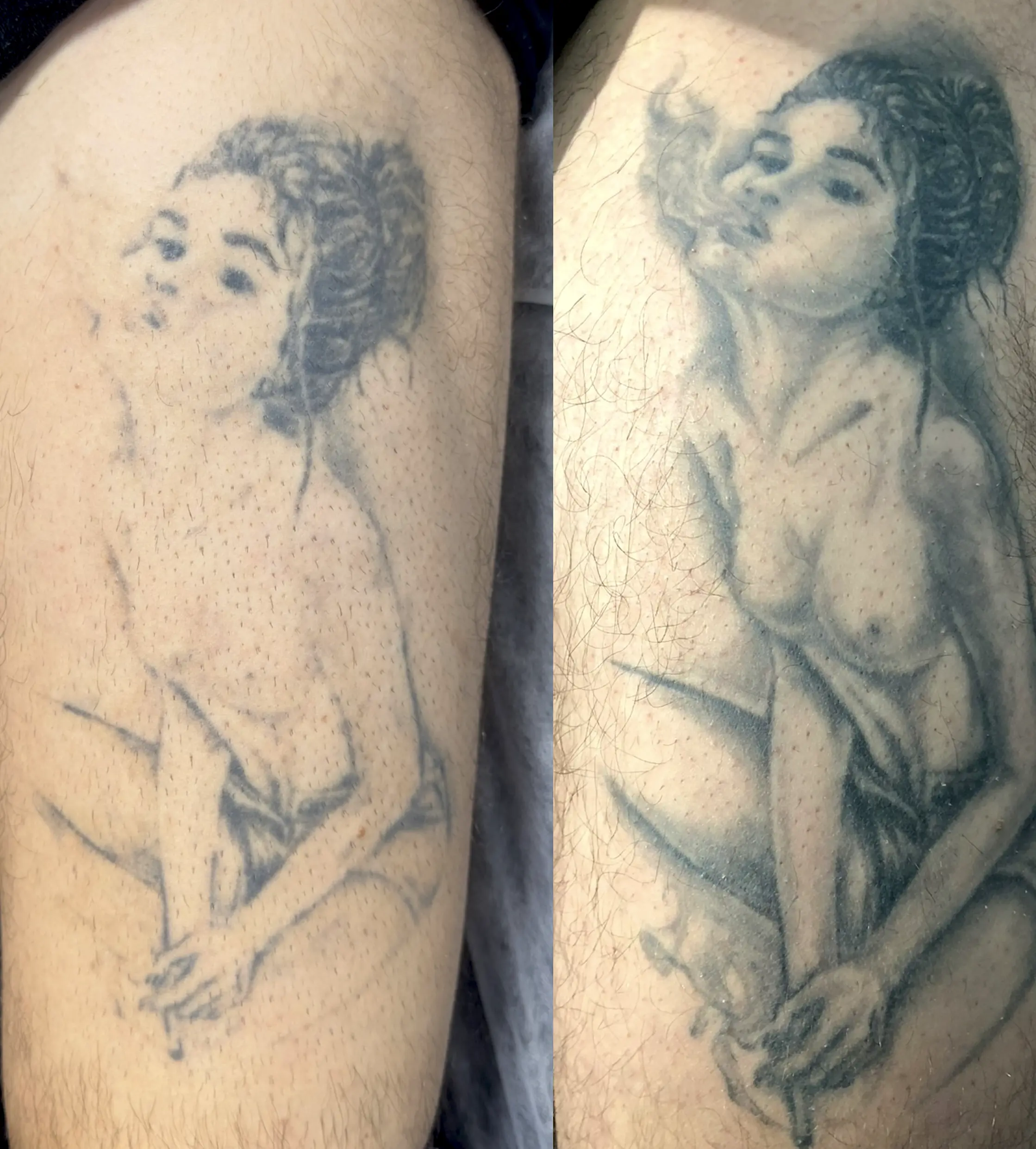 laser tattoo removal