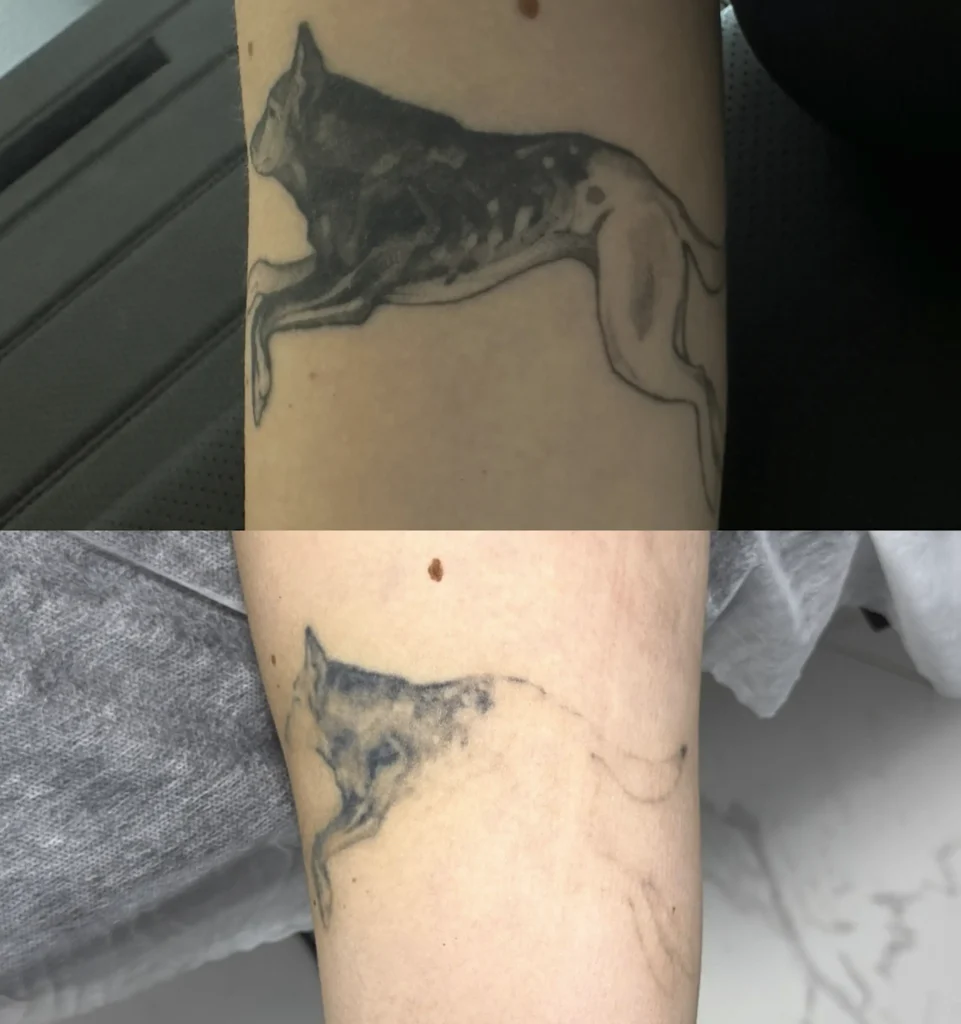 professional tattoo removal