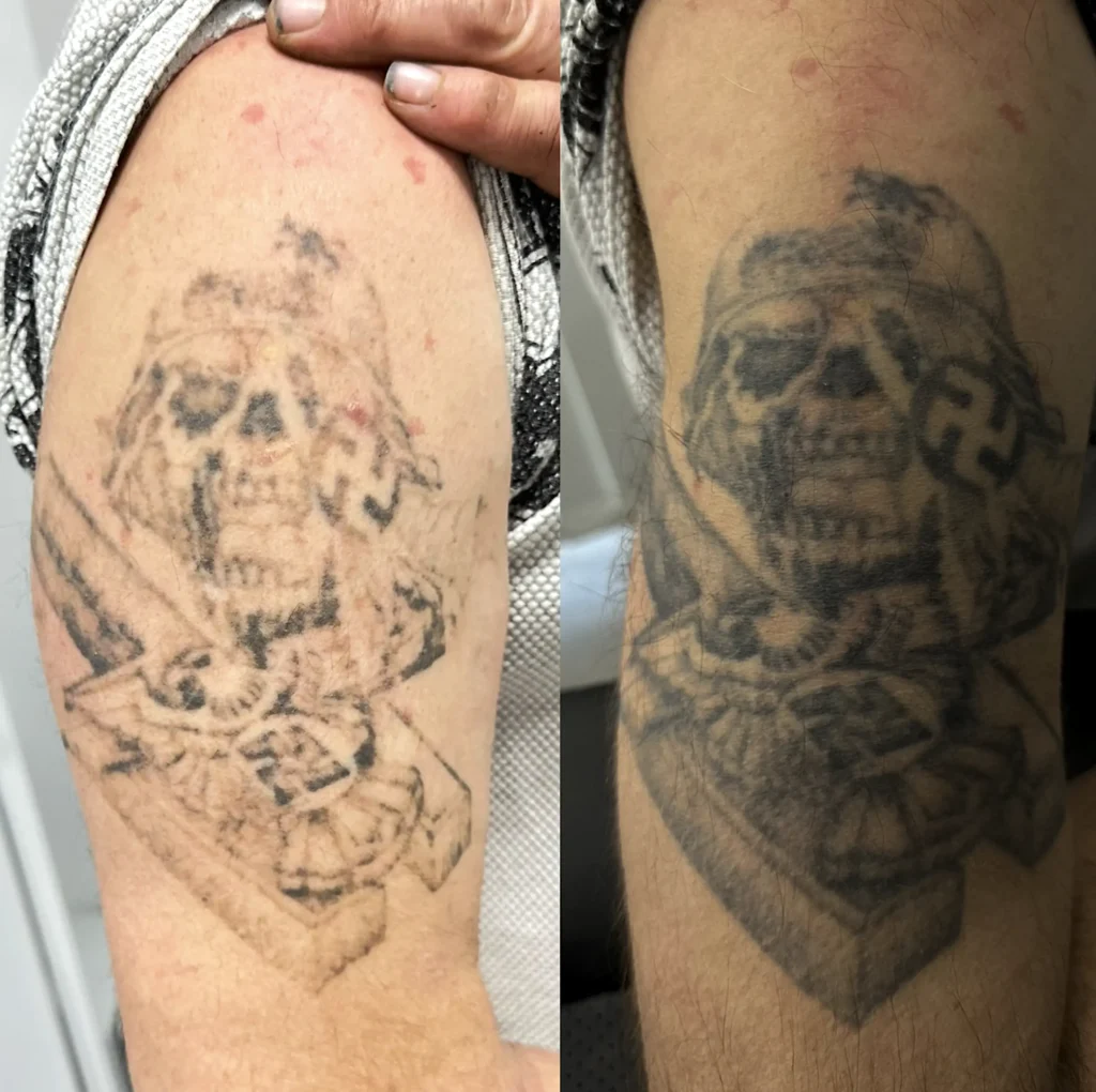 tattoo lazer removal