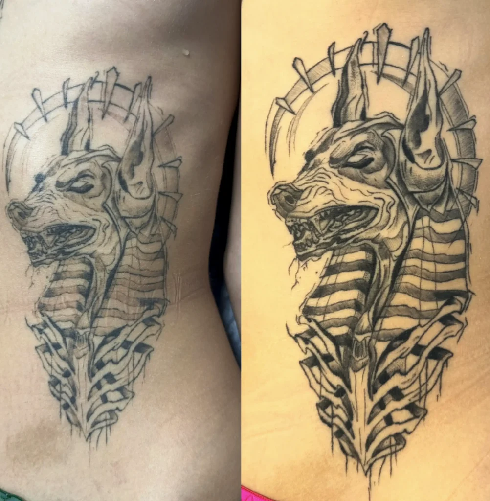 tattoo removal laser