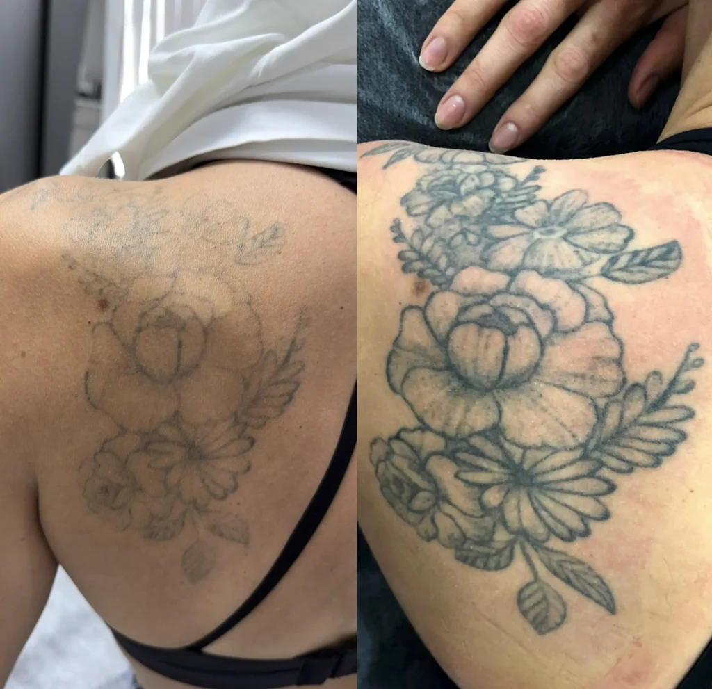 tattoo removal treatment
